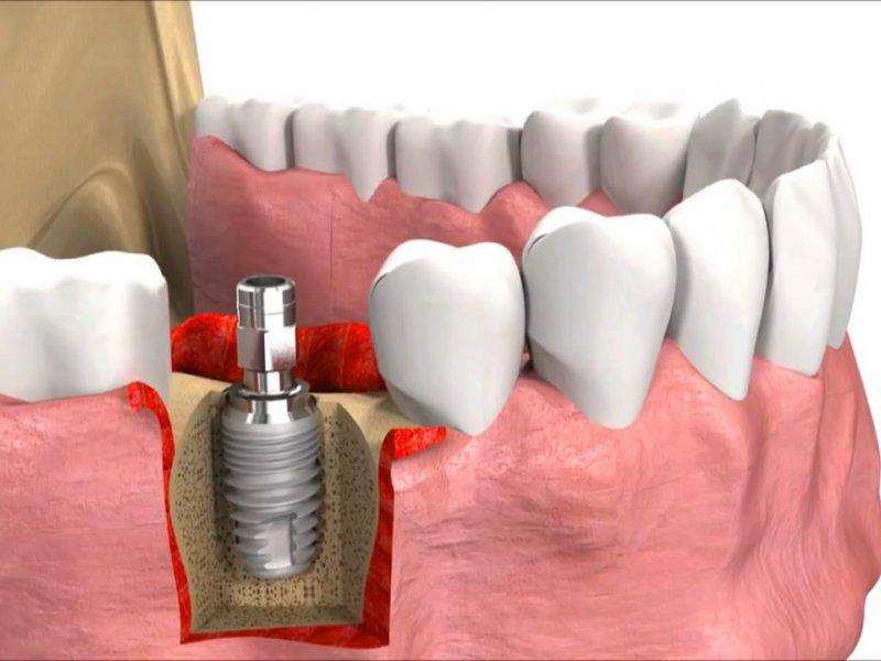 Implant tedavisi nedir? Hangi durumlarda uygulanır?